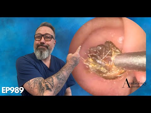 The MOST SATISFYING ring of dry ear wax removal!- EP989