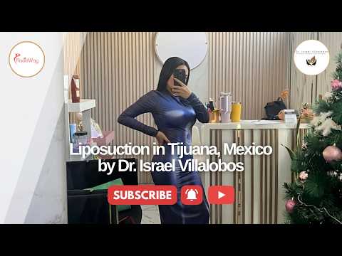 See the Difference with Liposuction in Tijuana, Mexico by Dr. Israel Villalobos