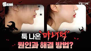 마녀턱(주걱턱) 원인 및 해결법❓｜윤곽수술｜김경회 원장