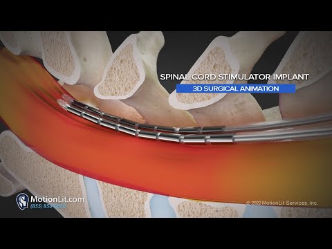 3D Surgery Animation of Spine Injury Portrays Spinal Cord Stimulator Implant