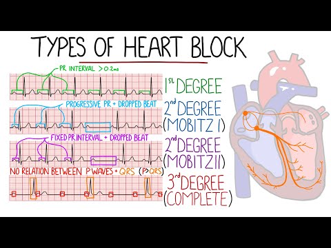 Heart Blocks Made Easy - 1st, 2nd (Mobitz 1/Wenckebach & Mobitz 2), 3rd (Complete) | with ECGs