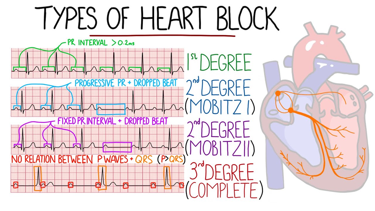 Heart Blocks Made Easy - 1st, 2nd (Mobitz 1/Wenckebach & Mobitz 2), 3rd (Complete) | with ECGs
