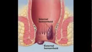 Hemorroides