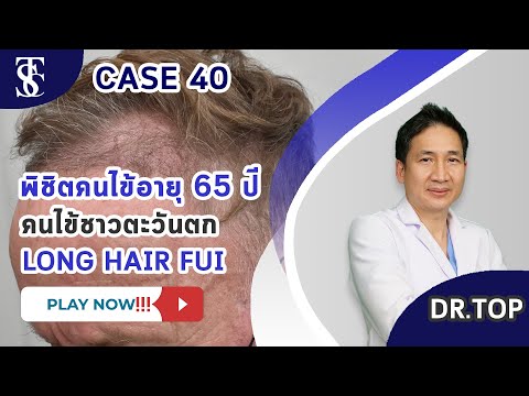 Patient 65 years old, treat the head in the frontal area.