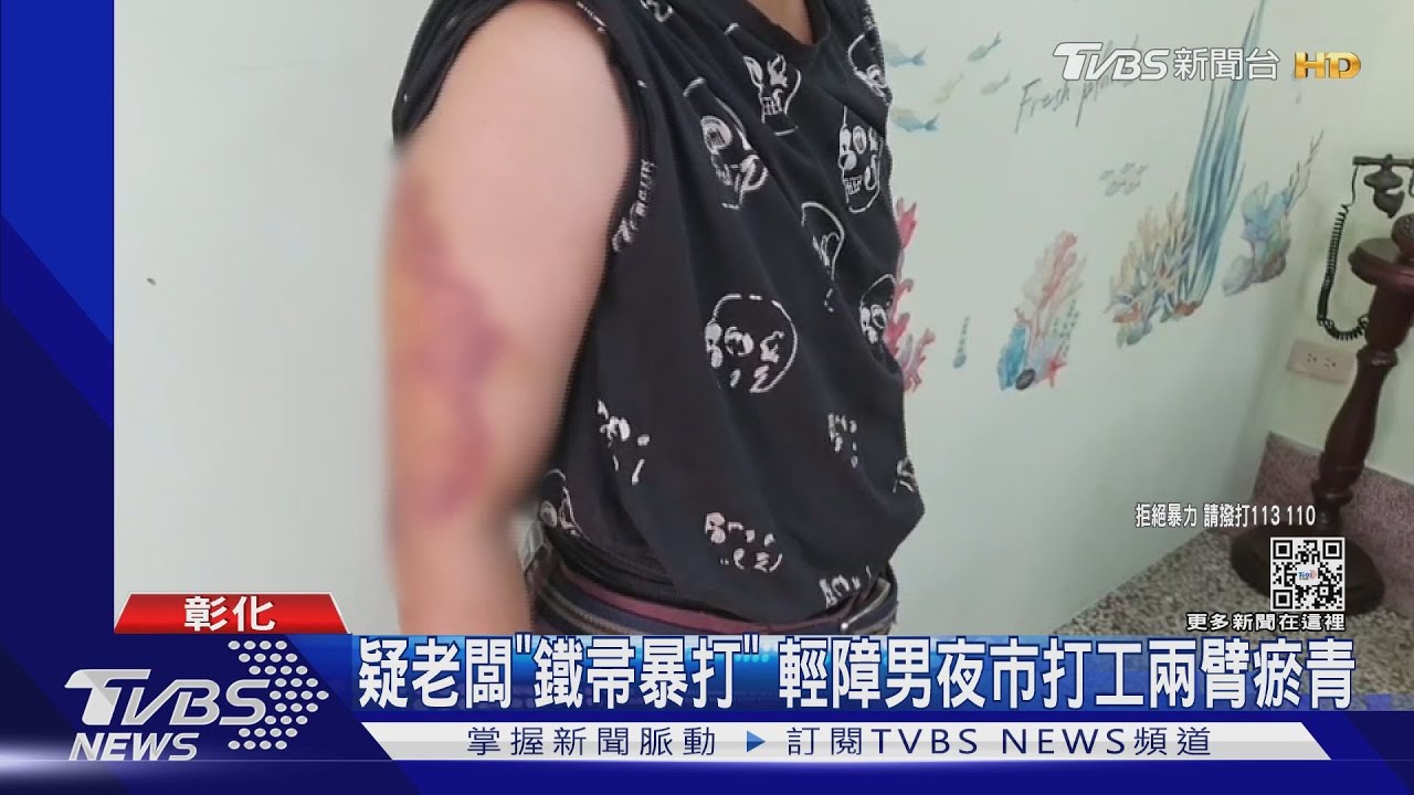 夜市打工領8百 老闆「鐵帚暴打」輕障男兩臂瘀青