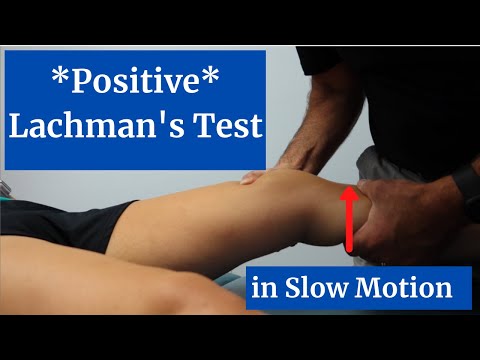 Modified Lachman s Test On a patient with a COMPLETE ACL TEAR