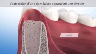 Comblement Préservation Alvéole post-extractionnelle