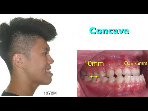 CC424. Nonsurgical Correction of A Severe Class III Malocclusion with Miniscrews