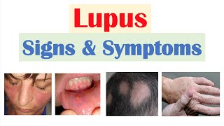 Lupus Signs & Symptoms (& Why They Occur) | Skin, Joints, Organ Systems