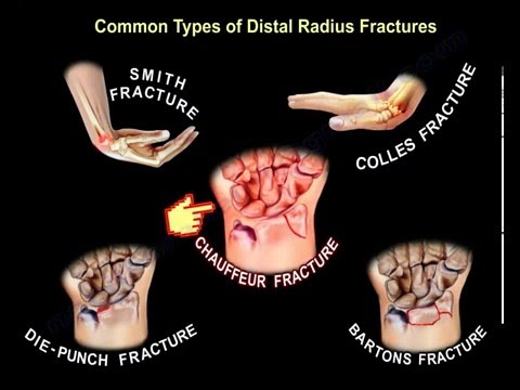 Common Types Of Distal Radius Fractures - Everything You Need To Know - Dr. Nabil Ebraheim