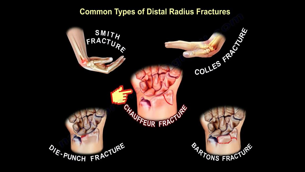 Common Types Of Distal Radius Fractures - Everything You Need To Know - Dr. Nabil Ebraheim