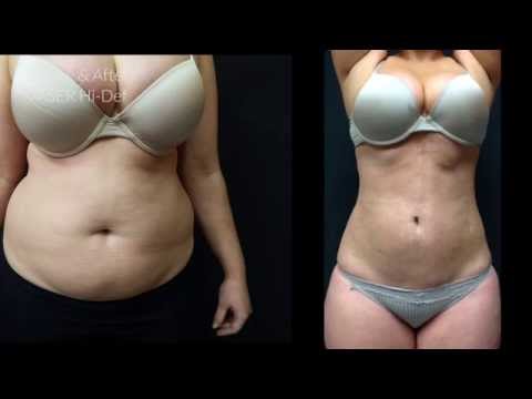 download lagu mp3 mp4 Liposculpture London, download lagu Liposculpture London gratis, unduh video klip Liposculpture London