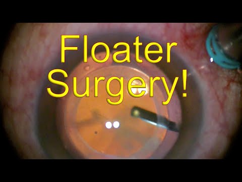Surgery for EYE FLOATERS (MASSIVE) - Vitrectomy for eye floaters - Dr Simon Chen
