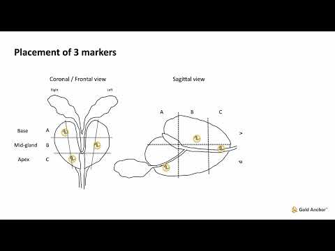 Gold Anchor fiducial placement — prostate IGRT