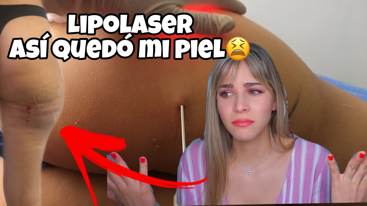 LIPOLASER 1 AÑO DESPUÉS *así quedó mil piel #laserlipolisis PARTE 3