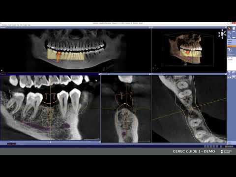 CEREC Guide 3 Demo