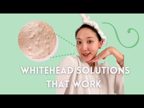 WHITEHEADS (aka those annoying tiny white bumps) - Main Causes & How To Get Rid of Them Long Term