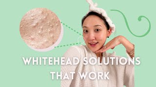WHITEHEADS (aka those annoying tiny white bumps) - Main Causes & How To Get Rid of Them Long Term