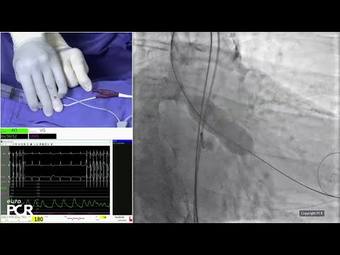 Align for the future with next-generation balloon expandable transcatheter heart valve technology