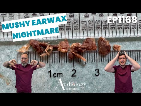 Deep Ear Wax Removal Compilation, Microsuction & Irrigation - EP1169