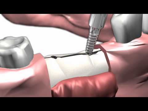 Dental Bone Spreading and Condensing Split Control System