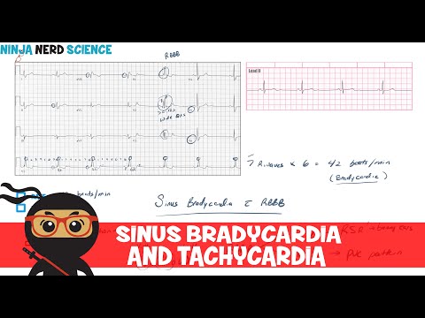 Rate and Rhythm | Sinus Bradycardia and Sinus Tachycardia