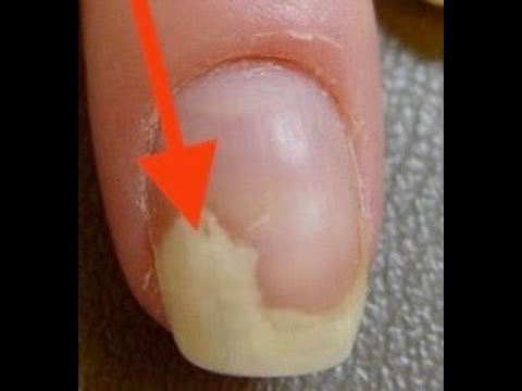Es steigt der Nagel auf dem Daumen des Beines bei gribke aus Die Behandlung der Schimmel der Nägel