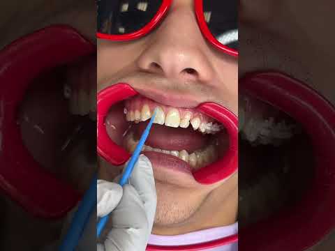 Putting on LightForce 3D Custom Braces