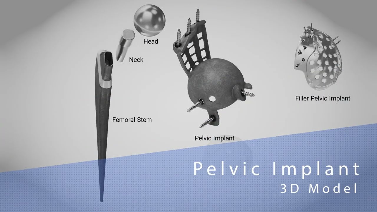 Beckenimplantat 3D Modell