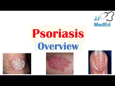 Psoriasis triggers meaning