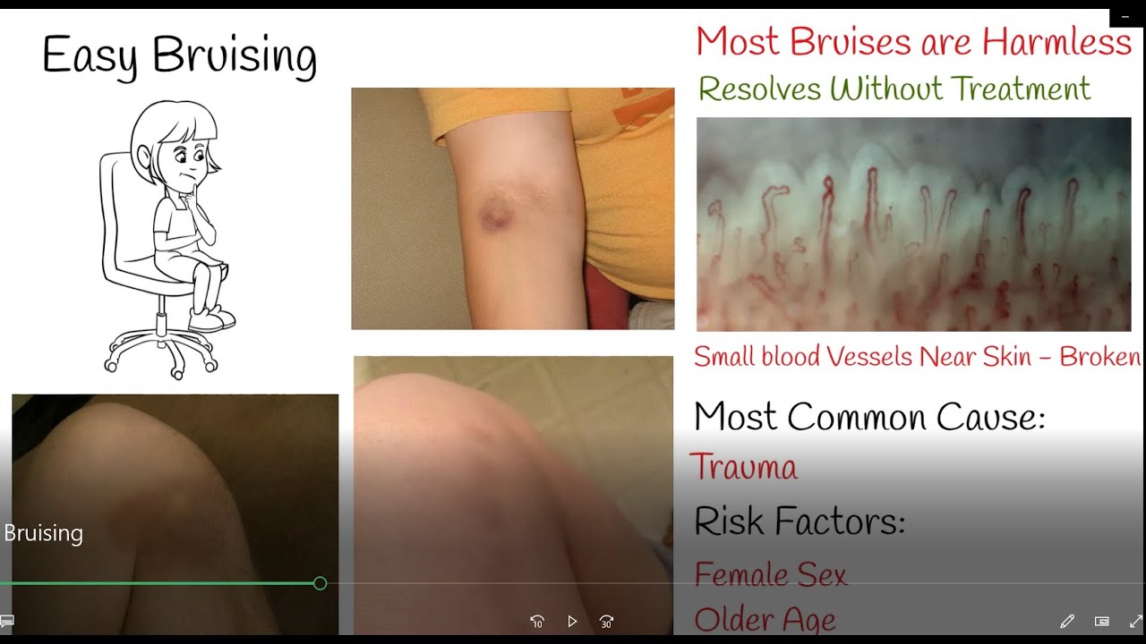 What does it mean if a bruise is raised? Tipseri