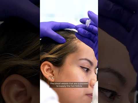 Botox for Hair Loss (vertical)