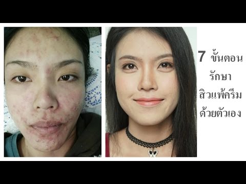 โรคผิวหนังภูมิแพ้ La Roche ก่อให้เกิด กรดซาลิไซลิครีมจัดอันดับโรคสะเก็ดเงิน