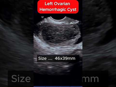 Ultraound Hemorrhagic Cyst - is this Serious ?