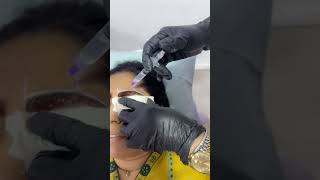 Eyebrow micro needling #phonk #music #eyebrows #drnabiharehman#shorts