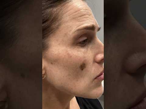 Laser Pico Pigment Spot Treatment