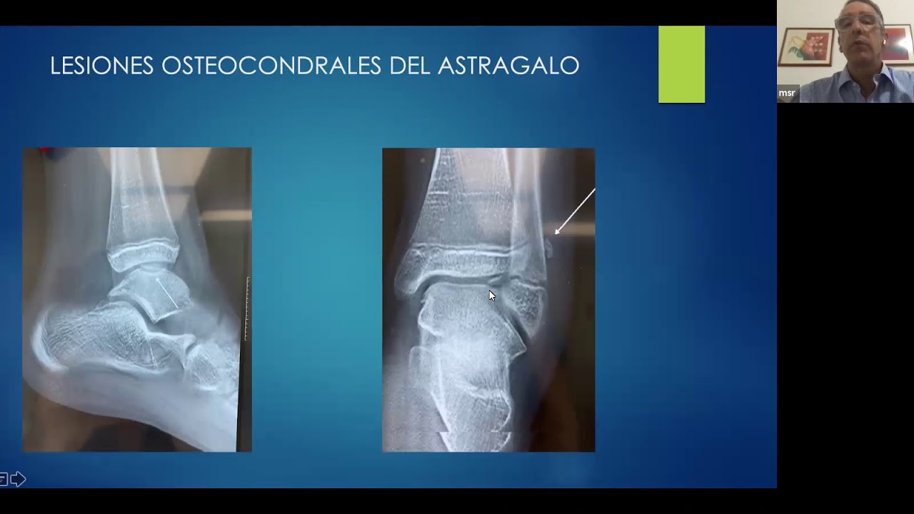 Watch Lesiones Osteocondrales del Tobillo Now Lesiones Osteocondrales del Tobillo