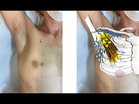 Estadiamento axilar dos linfonodos axilares pela ultrassonografia em pacientes com câncer de mama