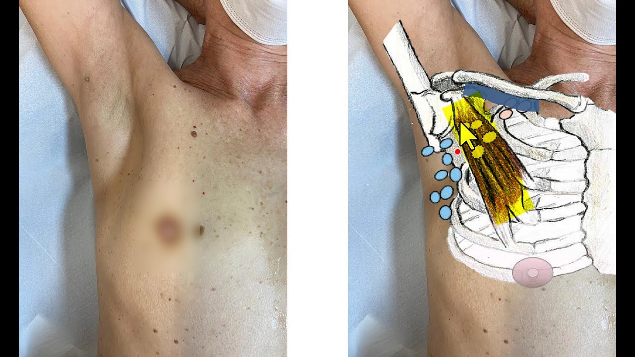 Estadiamento axilar dos linfonodos axilares pela ultrassonografia em pacientes com câncer de mama