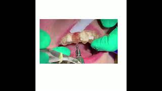 The process of a Biological Tooth Replacement in a single visit.