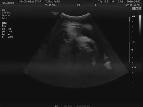 임신 38주 1일 초음파 영상 ( 이슬비침 )