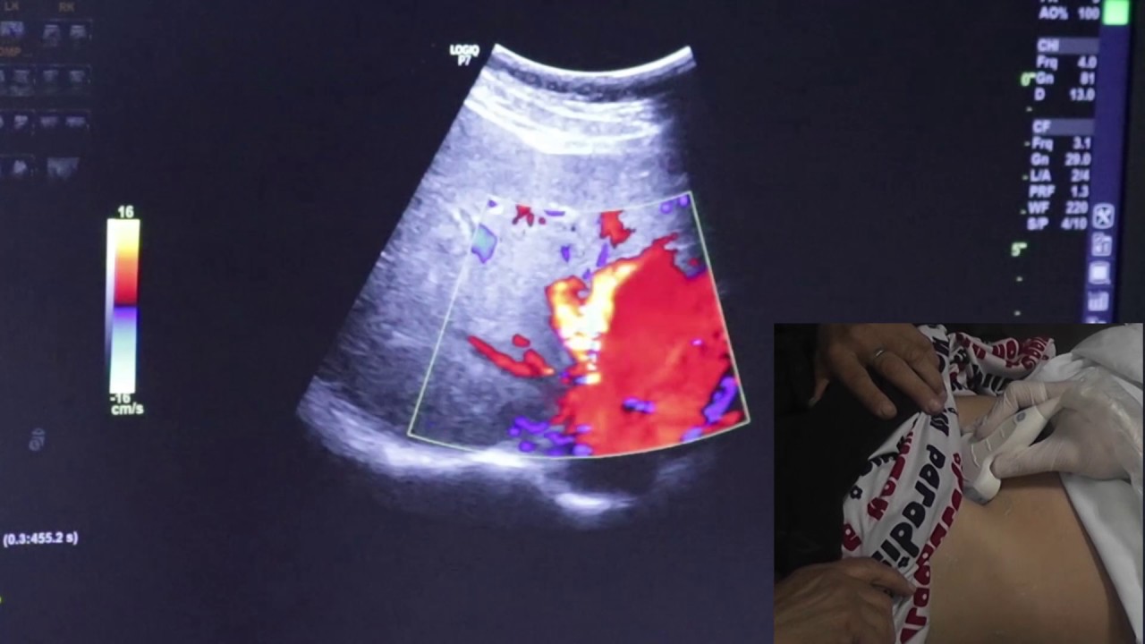 Portal Vein Doppler