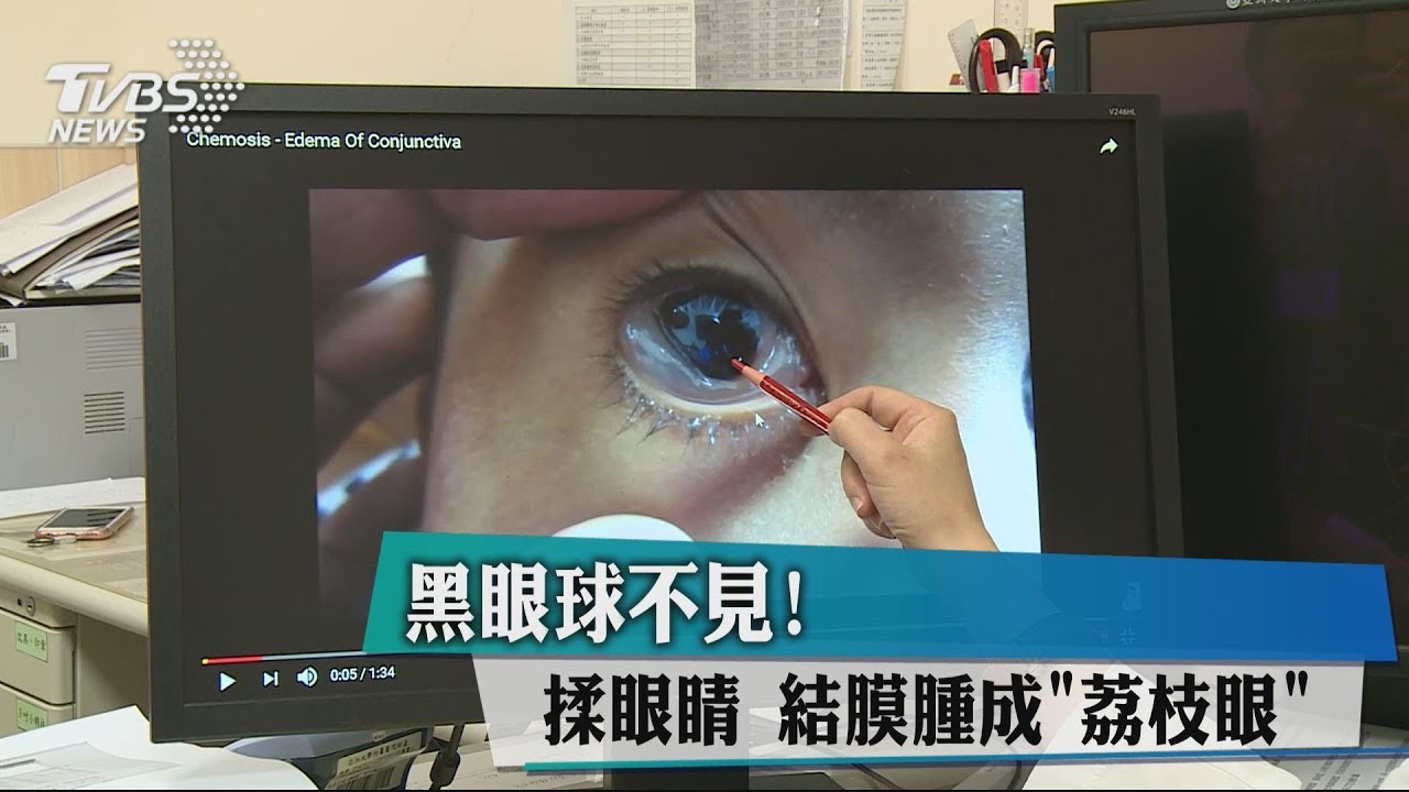 黑眼球不見!揉眼睛 結膜腫成「荔枝眼」