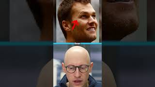 Did Tom Brady Have Plastic Surgery? | Plastic Surgeon Reacts
