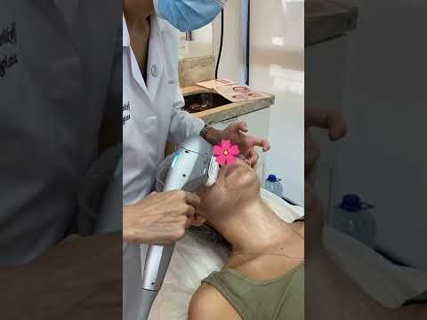 Tratamento para rugas da região perioral com Ultraformer 3.
