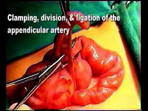 Anatomy Of Appendectomy