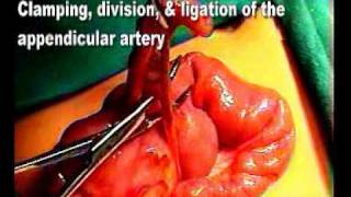 preview picture of video 'Applied anatomy of appendectomy'