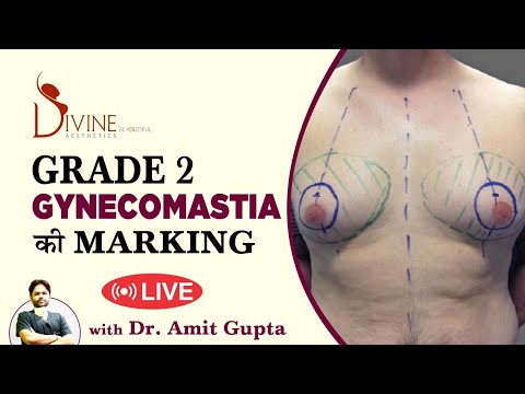 Grade 2 Gynecomastia की Marking - Live | Divine Cosmetic Surgery | Dr. Amit Gupta - February 2021