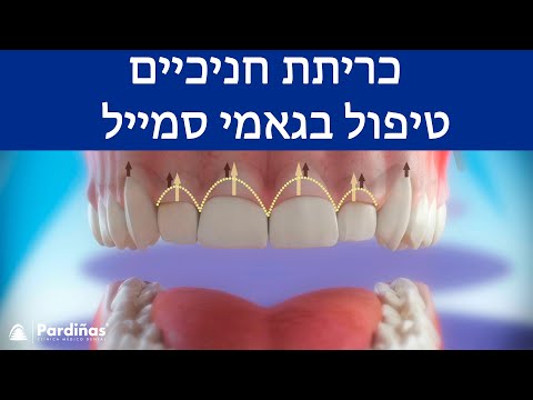 © כריתת חניכיים – טיפול בגאמי סמייל
