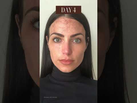 What to expect after IPL treatment! #IPL #cosmeticlaser #lasertreatment